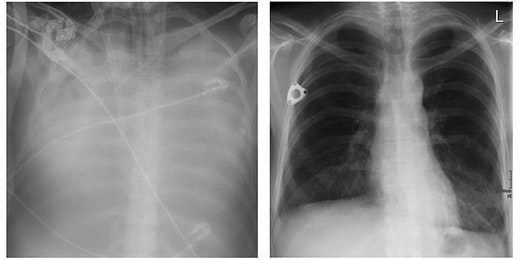 Sabines Lunge mit Covid-19; ihre neue Lunge (r.)