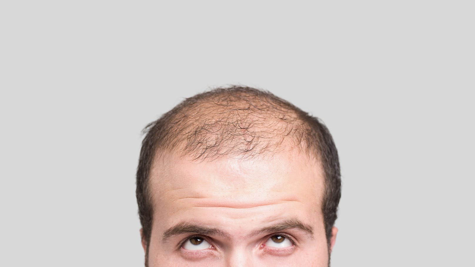 Rund ein Drittel aller Männer über 30 Jahren leiden unter Glatzenbildung, der Anteil steigt mit zunehmendem Alter.