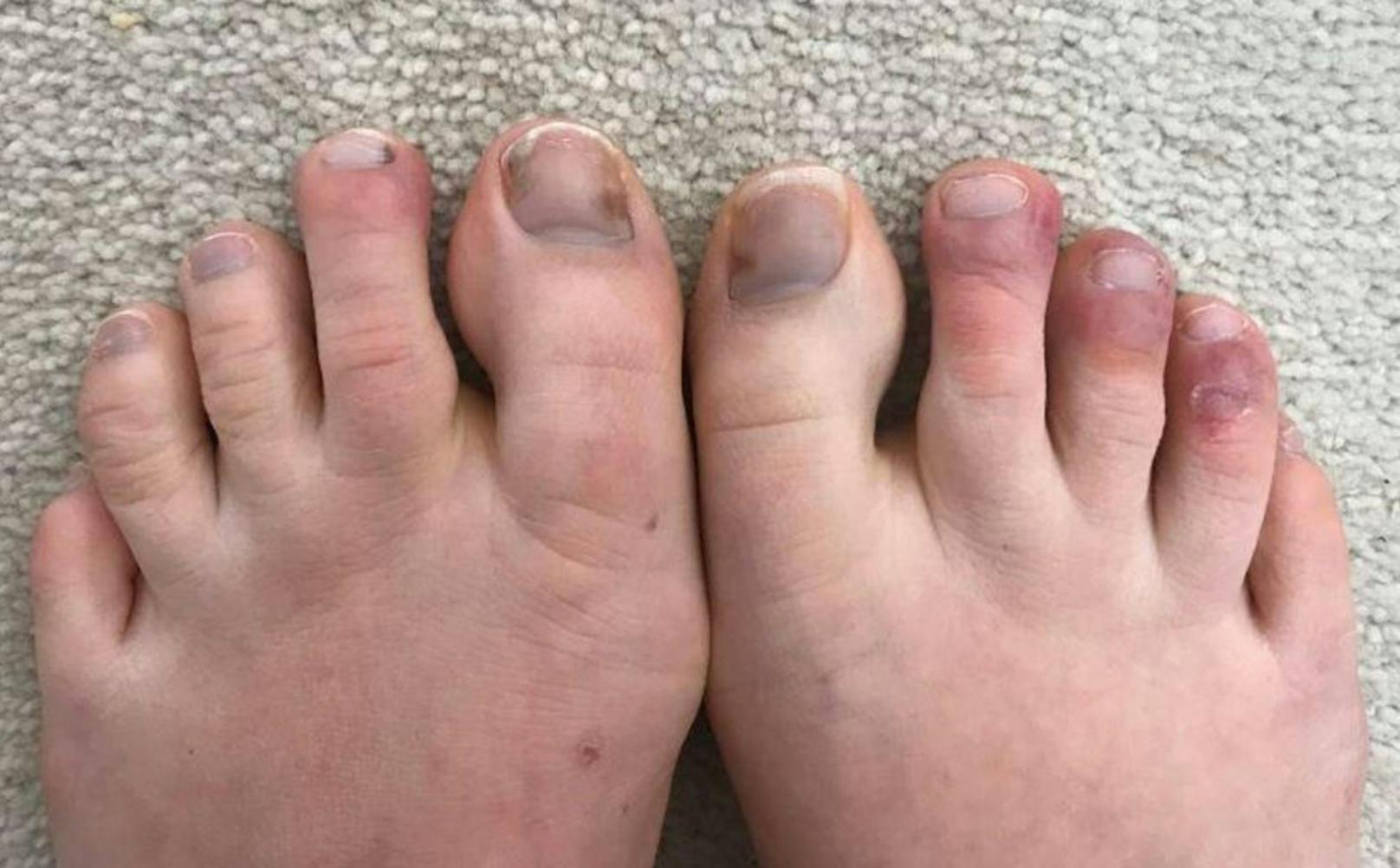 In mehreren Ländern sind bei Hautärzten vermehrt Menschen mit frostbeulenartigen Schwellungen an Zehen, Füßen oder Fingern aufgetaucht.