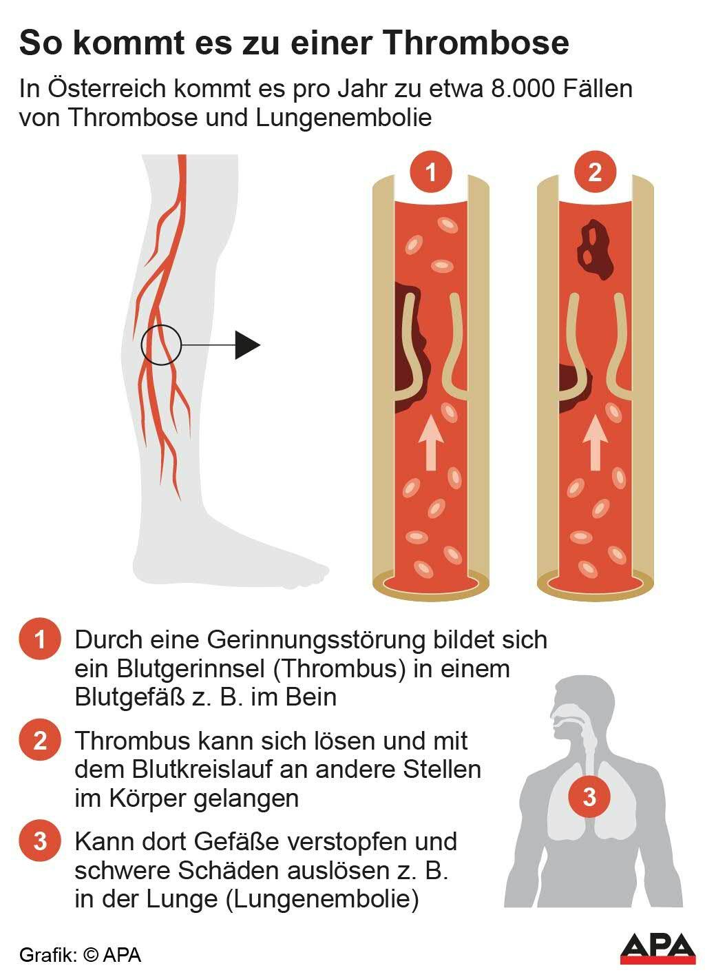 Schematische Darstellung Blutgerinnsel (Thrombus) mit Erklärung, mögliche Folgen;.Die Auslieferung der APA-Grafiken als Embed-Code ist ausschließlich Kunden mit einer gültigen Vereinbarung für Grafik-Pauschalierung vorbehalten. Dabei inkludiert sind automatisierte Schrift- und Farbanpassungen an die jeweilige CI. Für weitere Informationen wenden Sie sich bitte an unser Grafik-Team unter grafik@apa.at. GRAFIK 0366-21, 88 x 120 mm - 20210316_PD2895 - Rechteinfo: Rights Managed (RM)