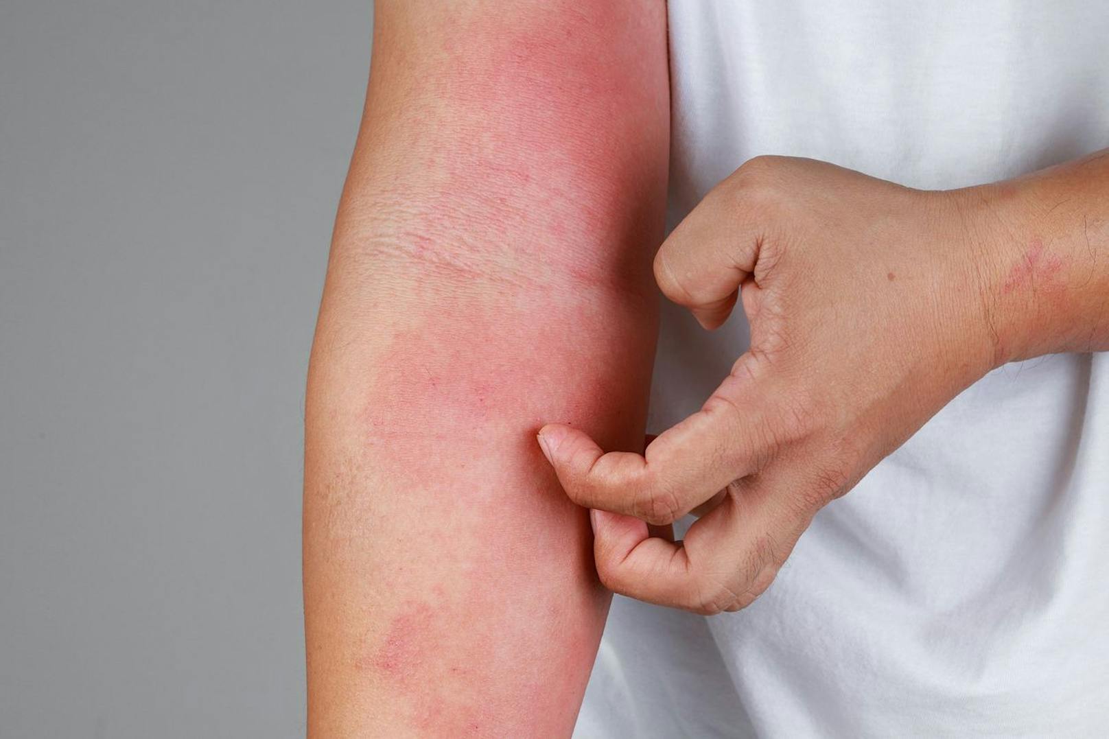 Auch die Haut kann bei einer Corona-Infektion reagieren.