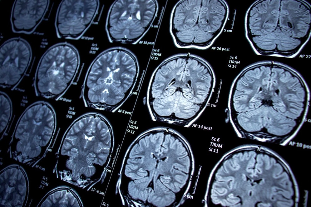 Aufnahmen aus dem Magnetresonanztomograph zeigen: Akademiker sind nicht besser geschützt als Nicht-Akademiker.<br>