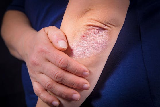 Auch mit einer Psoriasis-Erkrankung wird die Corona-Impfung empfohlen.
