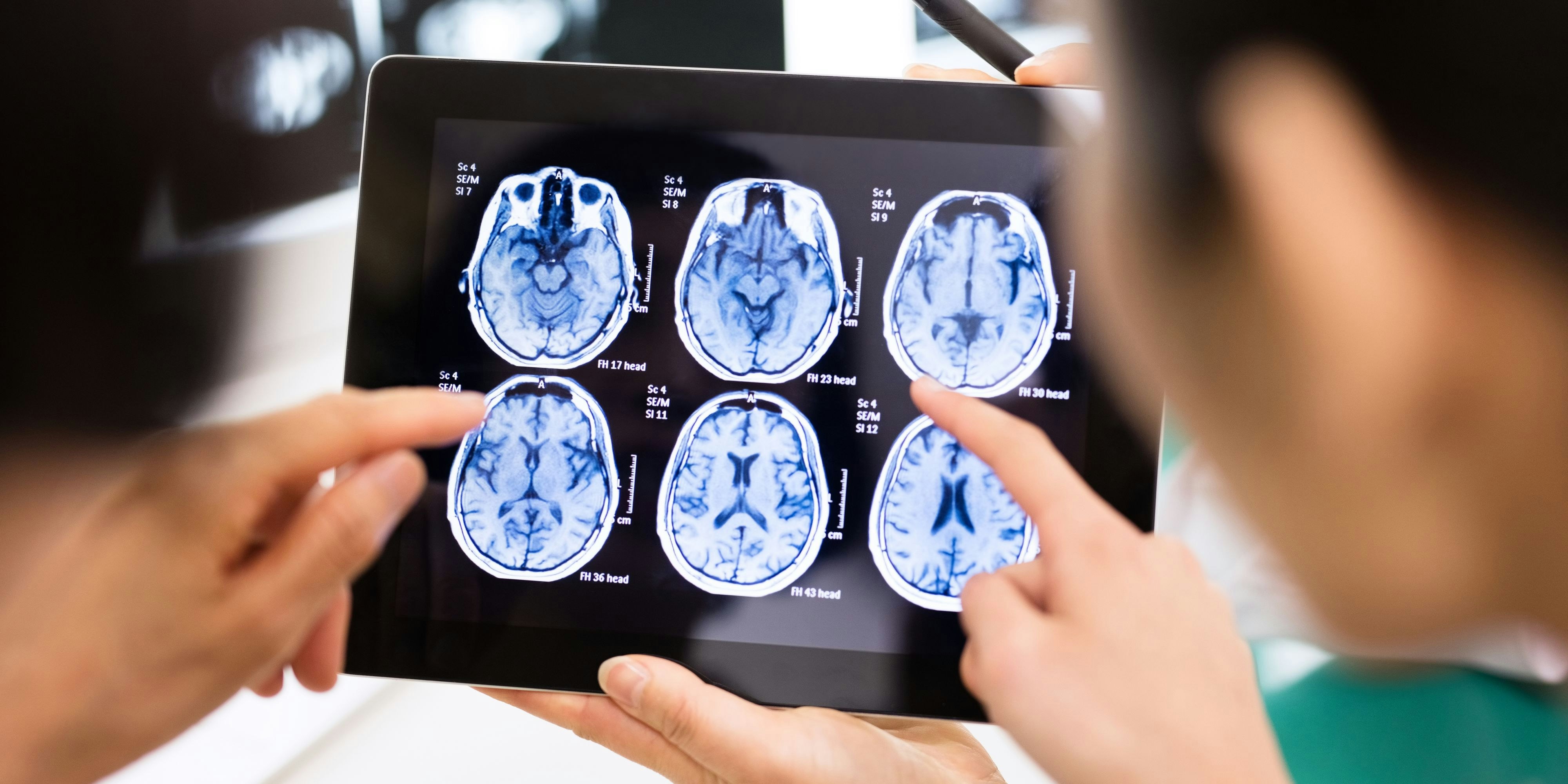 Eine mysteriöse Gehirnerkrankung ist in der kanadischen Provinz New Brunswick aufgetreten