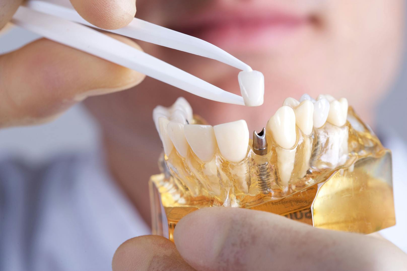 Für ein Zahnimplantat braucht es Knochen, ist dieser nicht mehr vorhanden, wird es mühsam.