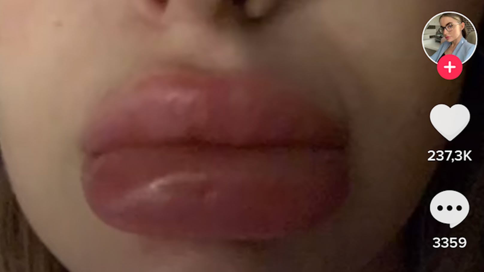 Auf TikTok mehren sich Videos, bei denen Frauen mit aufgespritzten Lippen über geschwollene Gesichter nach einer Corona-Impfung klagen.