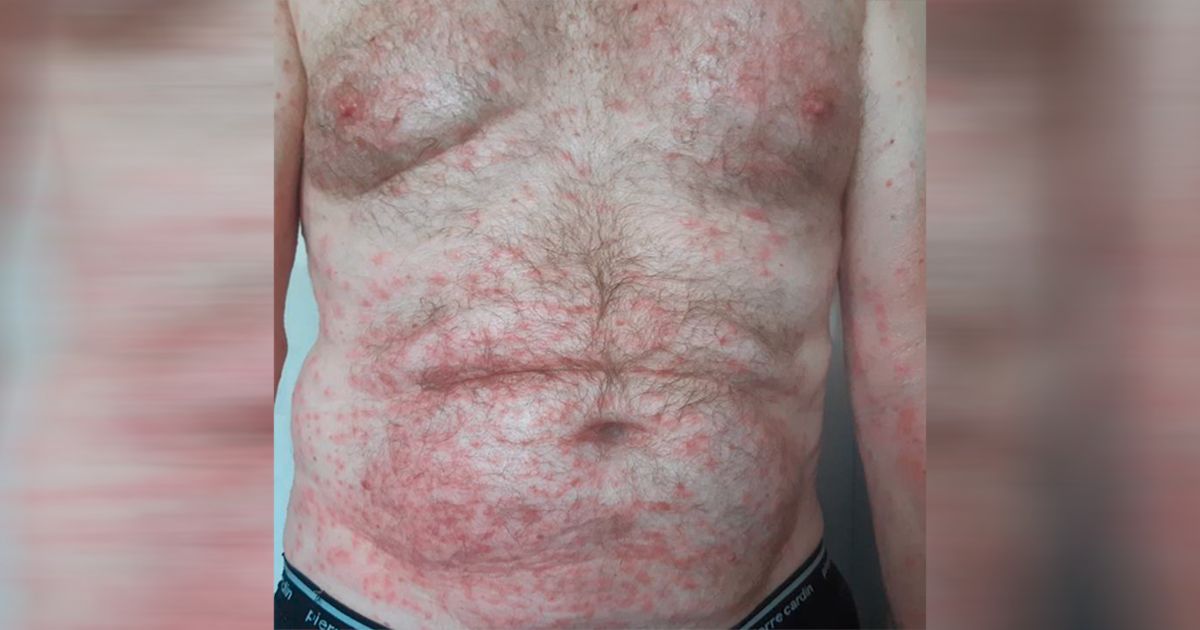 Sepp Sennhauser bekam nach dem Kontakt mit der Giftraupe am ganzen Körper heftige Pusteln.