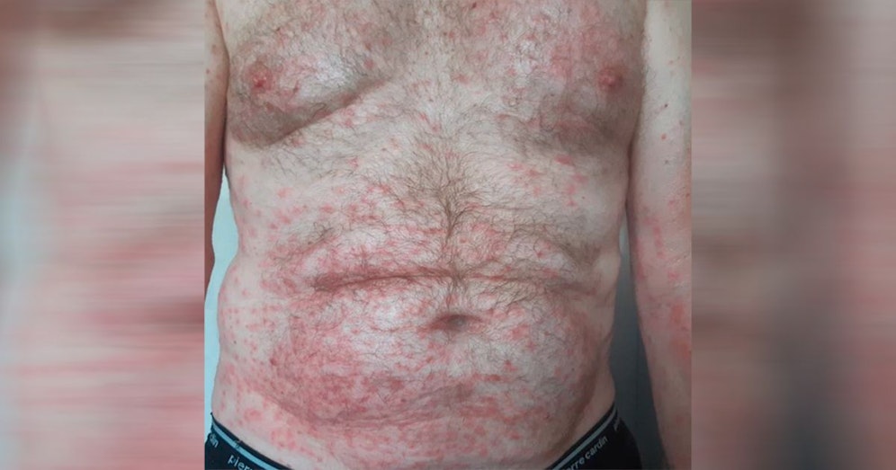 Sepp Sennhauser bekam nach dem Kontakt mit der Giftraupe am ganzen Körper heftige Pusteln.