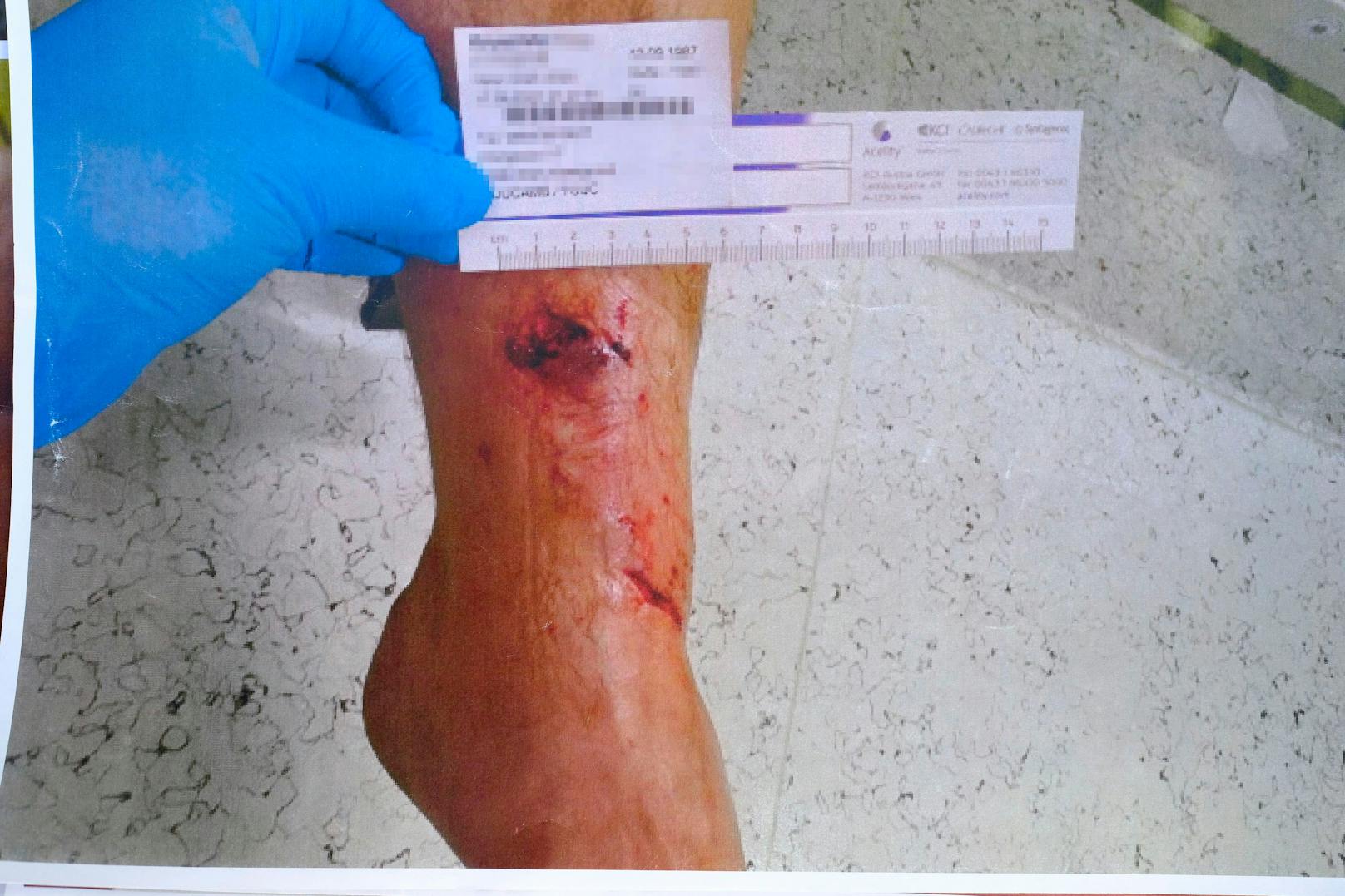 Der passionierte Wildschweinjäger erlitt zwei Bisse am Bein.