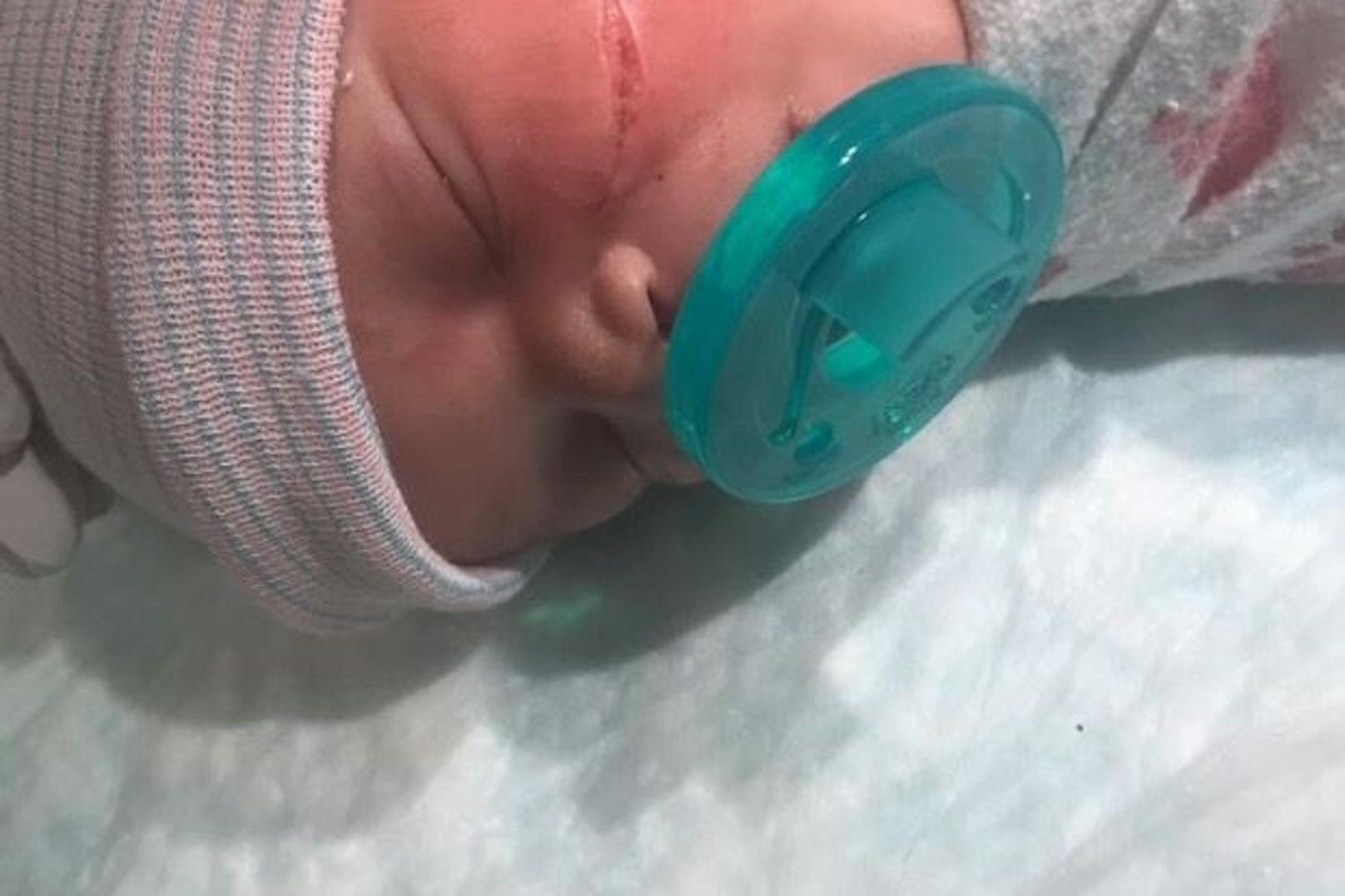 Arzt zerschneidet Baby bei Kaiserschnitt das Gesicht