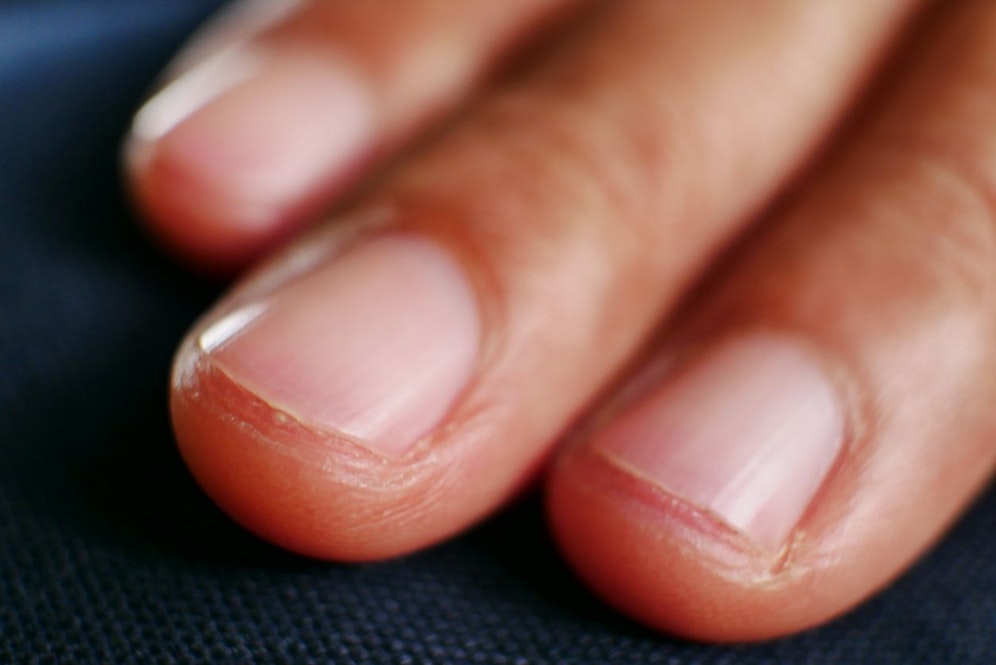 Schwere Erkrankungen zeigen sich unter anderem auch im Nagelwachstum.