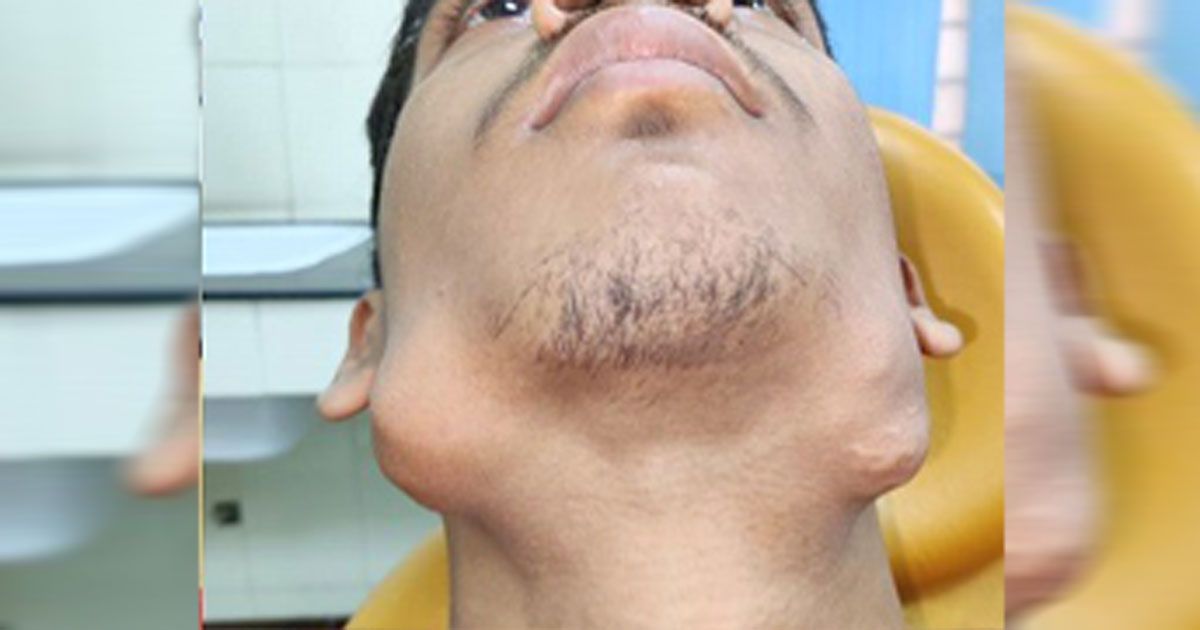 Nitish Kumar hatte 82 Zähne zu viel in seinem Kiefer.