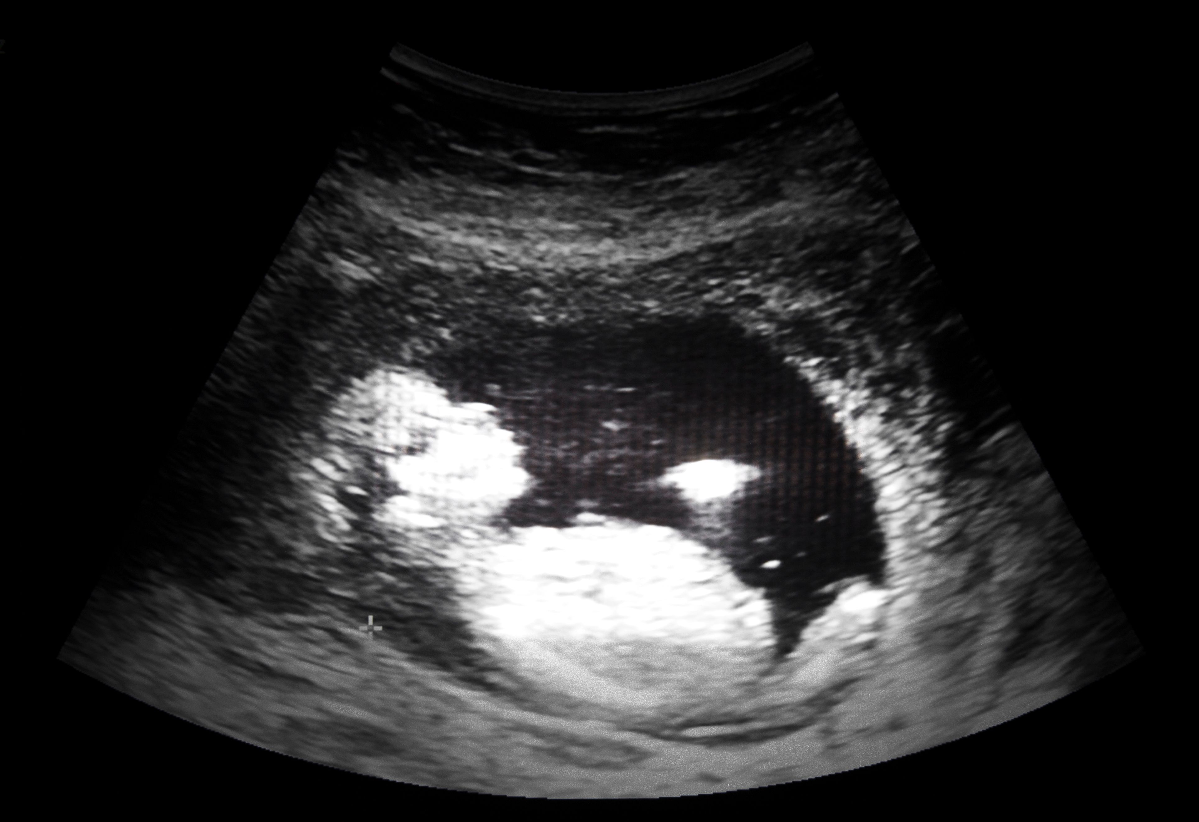 ultrasound film of thirteen week fetus