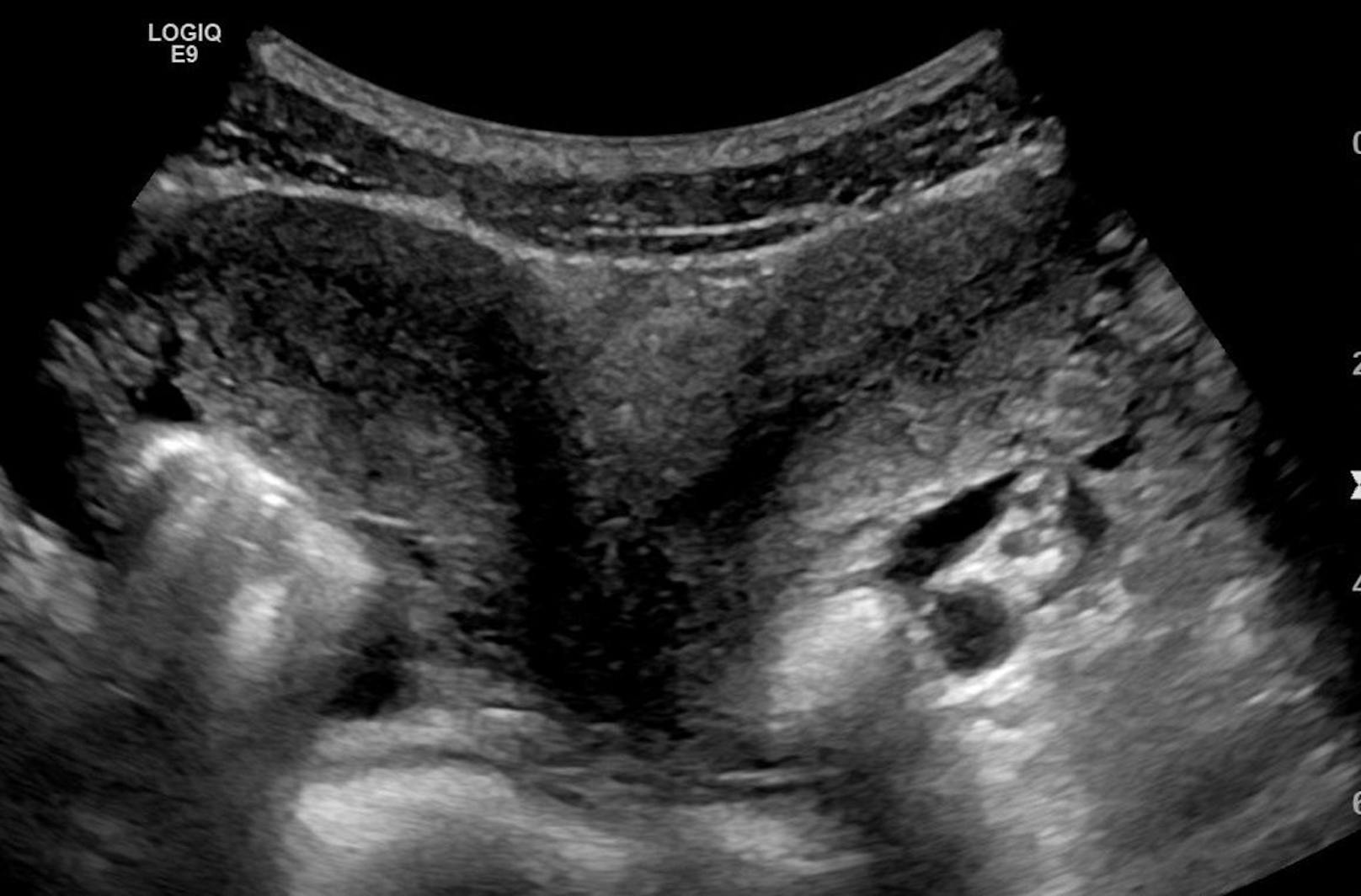 Statt der normalen Birnenform zeigt der Uterus didelphys eine V-Form. <br>