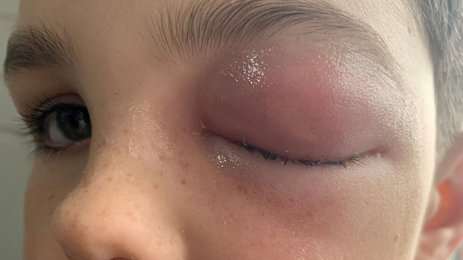 Eine Woche, nachdem Zac positiv auf das Coronavirus getestet wurde, schwoll sein linkes Auge gefährlich an.