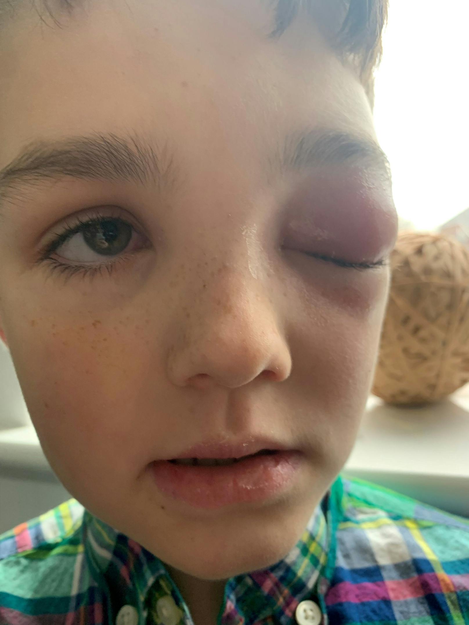 Ein 9-jähriger Zac Morey aus Bristol (England) erblindete fast aufgrund einer seltenen Nebenwirkung der Corona-Erkrankung.