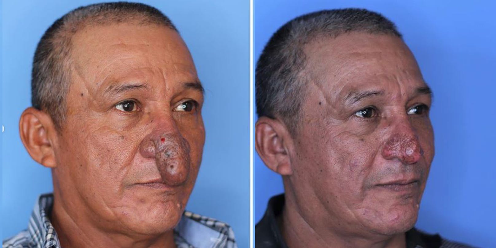 Vor und nach der Nasen-Operation: Conrado Estrada litt an einer seltenen Hautkrankheit