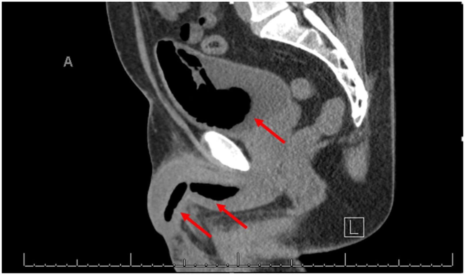 Auf den Röntgen- und Computertomografie-Bildern eines Mannes aus den USA ist unschwer zu erkennen, dass sich ein Fremdkörper in seiner Blase befindet.