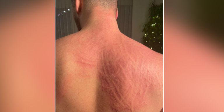 Seit Michel B. (23) seine Boosterimpfung erhielt, leidet er unter extremen Hautreizungen und starkem Ausschlag.