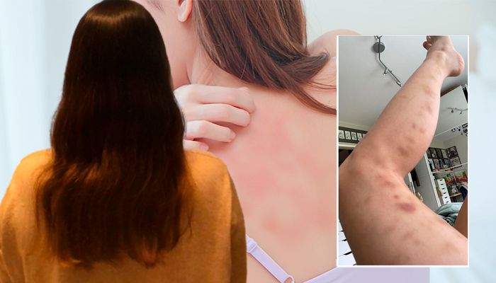 Eine Wienerin (links) hatte heftigen Ausschlag, ihre Schwester (rechts) war übersäht mit blauen Flecken.