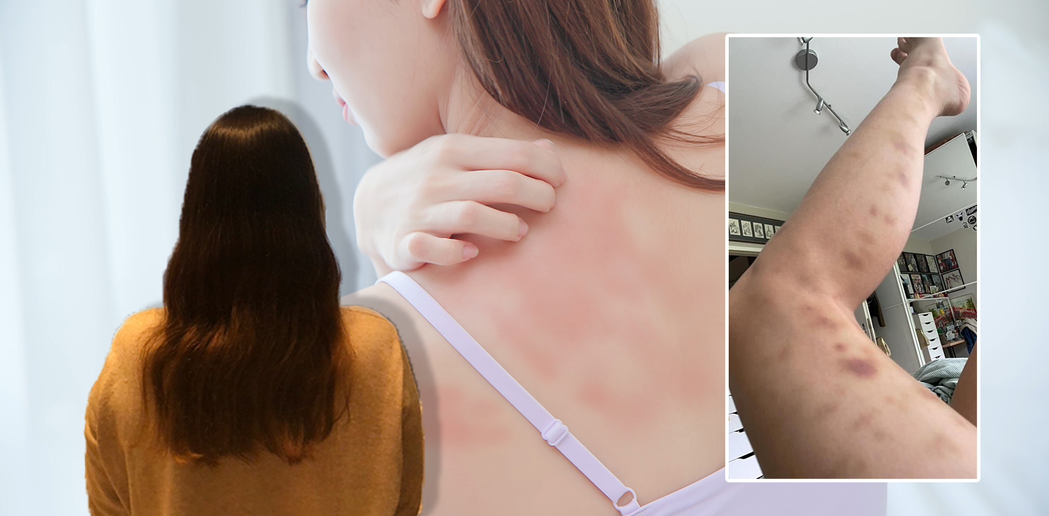 Eine Wienerin (links) hatte heftigen Ausschlag, ihre Schwester (rechts) war übersäht mit blauen Flecken.