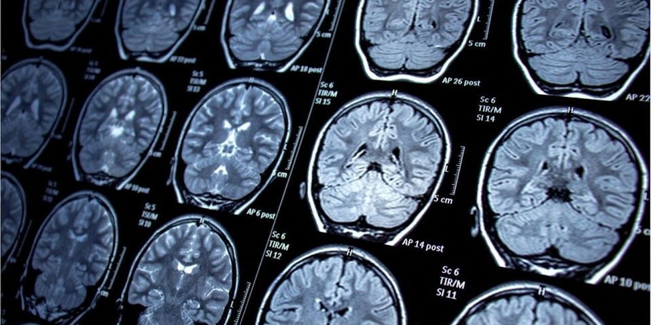 Das passiert wirklich im Gehirn, wenn wir sterben - Science | heute.at