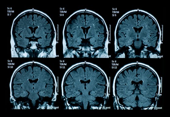 Laut einer britischen Studie soll Corona das Hirn schrumpfen und die kognitive Leistung verringern. (Symbolbild)