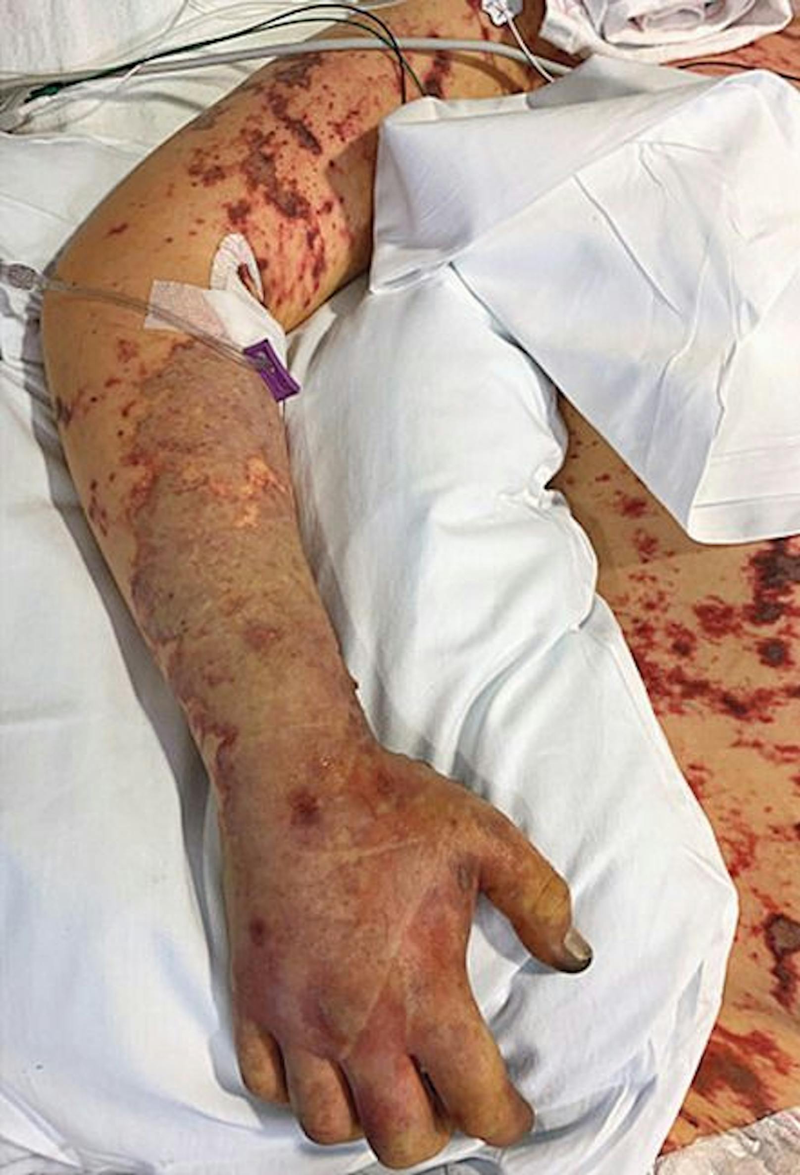 Das Hautgewebe wird nicht mehr durchblutet, färbt sich violett und fängt an zu faulen. In Folge mussten dem 19-Jährigen&nbsp;ein Teil aller 10 Finger amputiert werden, ebenso wie beide Beine unterhalb der Knie.