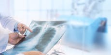Studie: Wie Lungenkrebs-Früherkennung machbar wäre