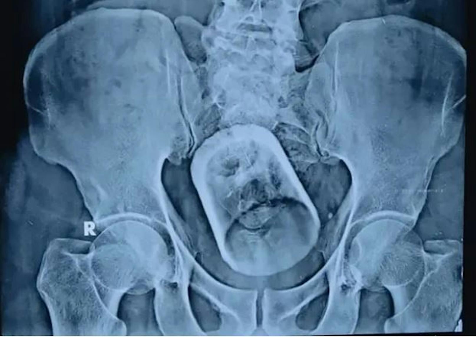 Da staunten die Ärzte nicht schlecht, als das Röntgenbild den Grund für die Beschwerden des Patienten zeigte.