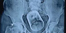 "Versehentlich verschluckt": Ärzte finden Glas im Darm