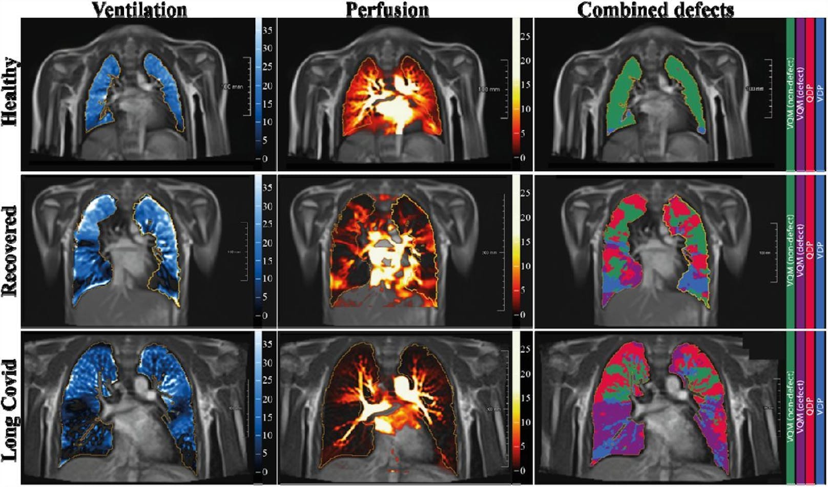 LF-MRT-Bilder für Beatmungsdefekte, Durchblutungs-(Perfusions-)defekte und kombinierte Defekte bei einem gesunden (obere Reihe), einem genesenen (mittlere Reihe) und einem Long Covid-Patienten (untere Reihe).