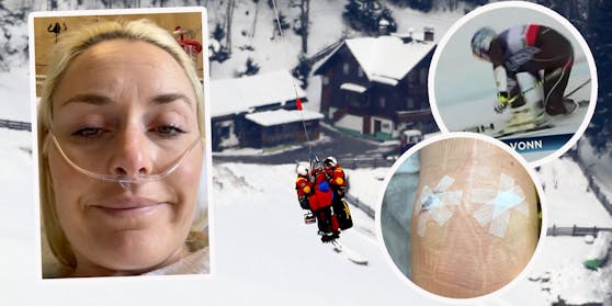 Lindsey Vonn erlitt in ihrer Karriere schwere Stürze. Auch in der Ski-Pension benötigt sie noch Operationen.