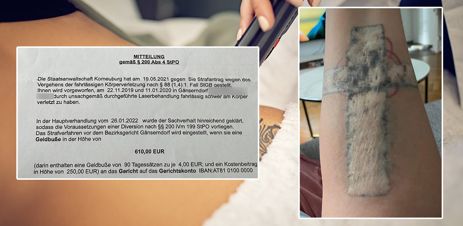 Obwohl sie die Narben einer verpfuschten Tattoo-Entfernung ein Leben lang trägt, bekam eine 28-Jährige nur 1.000 € Schmerzensgeld. (Symbolbild)