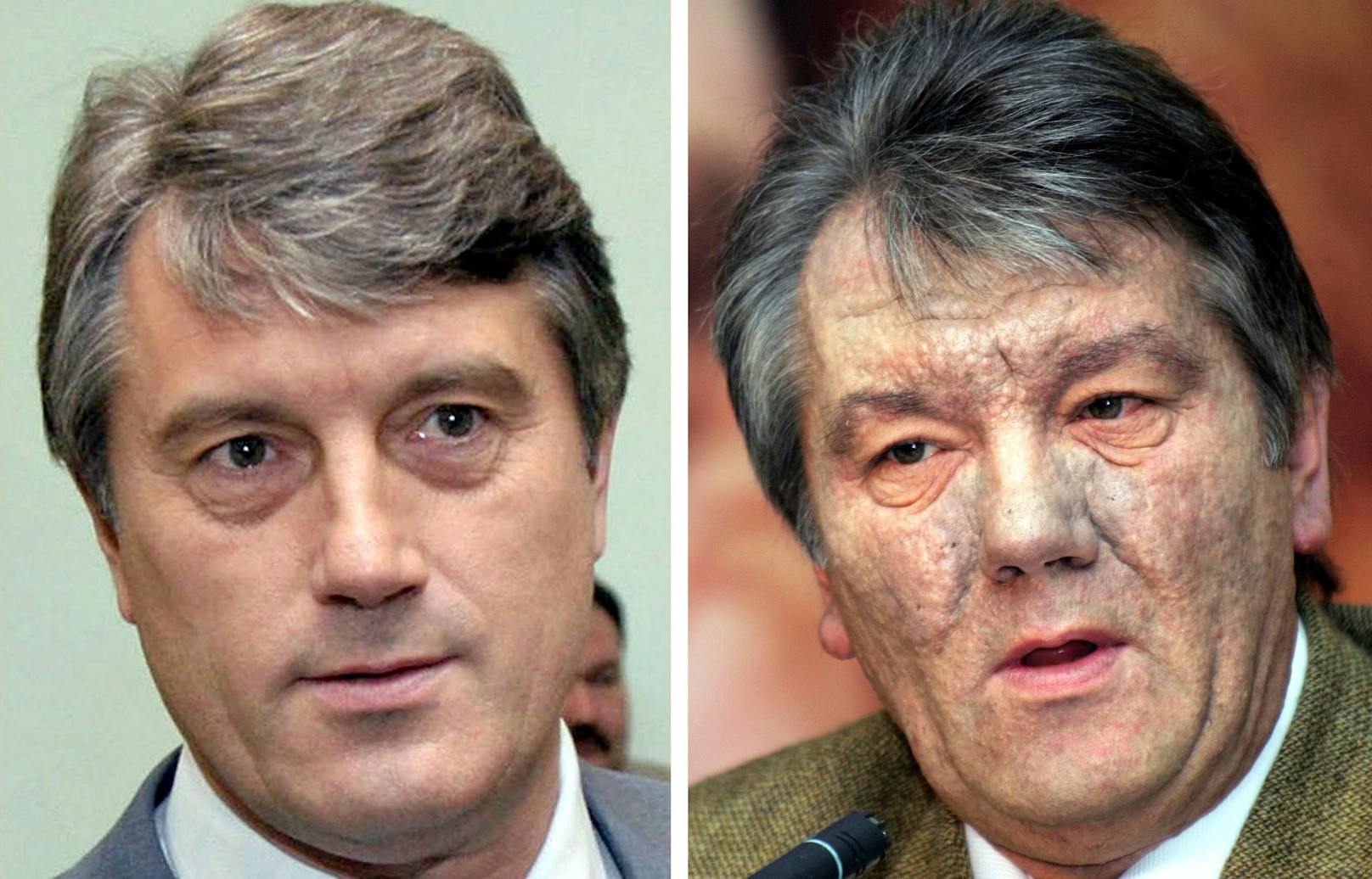 Viktor Juschtschenko im Juli 2004 und im Dezember 2004 mit völlig entstelltem Gesicht nach dem Gift-Anschlag.&nbsp;