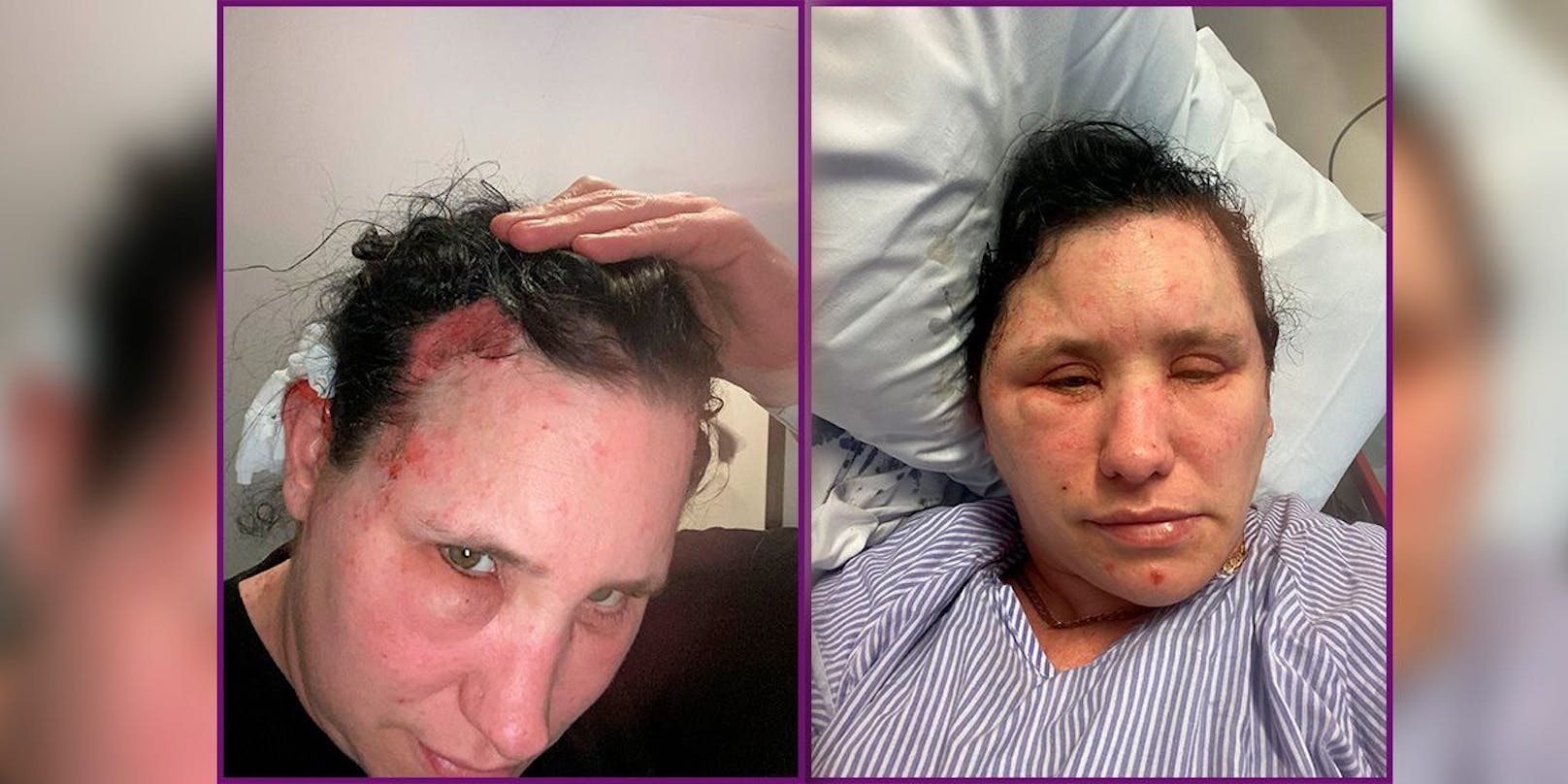 Geschwollen und verletzt: Die Fotos zeigen das Ausmaß von Jessies Körperreaktion auf das Haarfärbemittel.