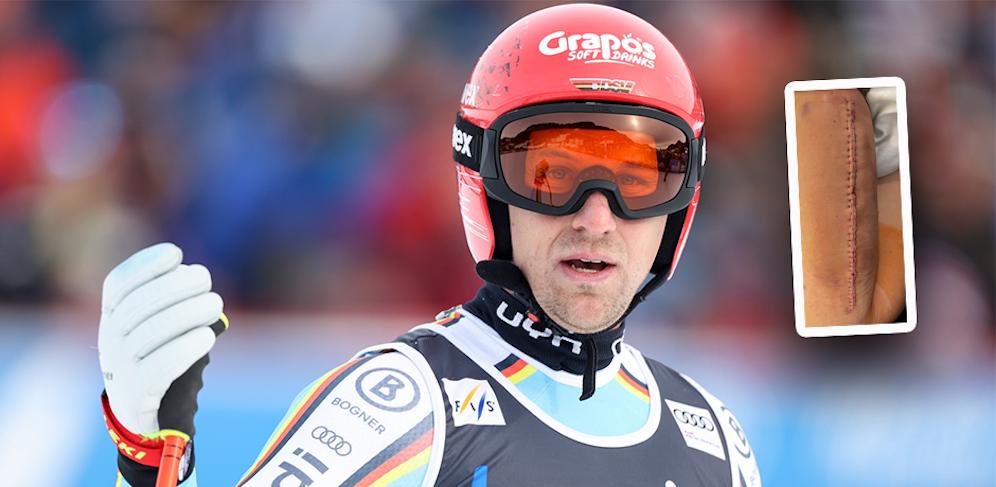 Pepi Ferstl zeigt auf Instagram seine OP-Narbe. 