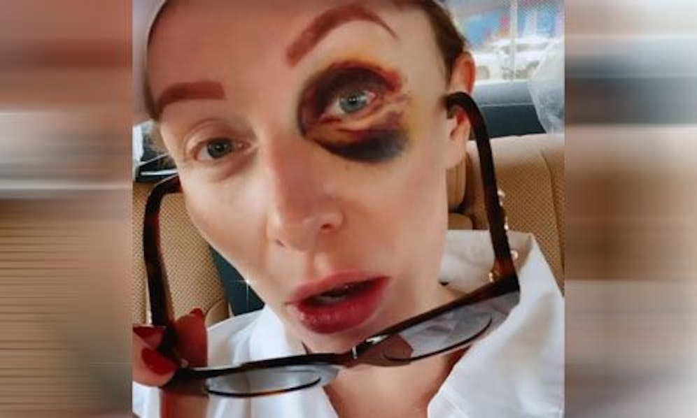 Georgina zeigt an ihrem Geburtstag ihr blaues Auge.