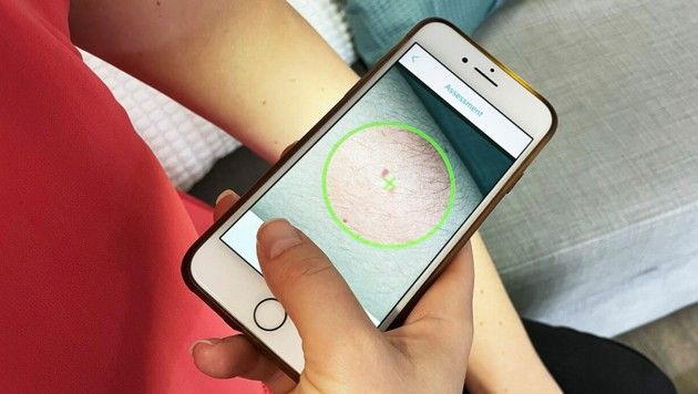 SkinScreener analysiert Muttermale mit künstlicher Intelligenz.