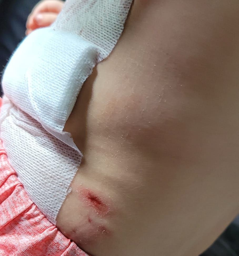 Das Mädchen wurde auch am Oberkörper in der Nähe der Lunge verletzt.