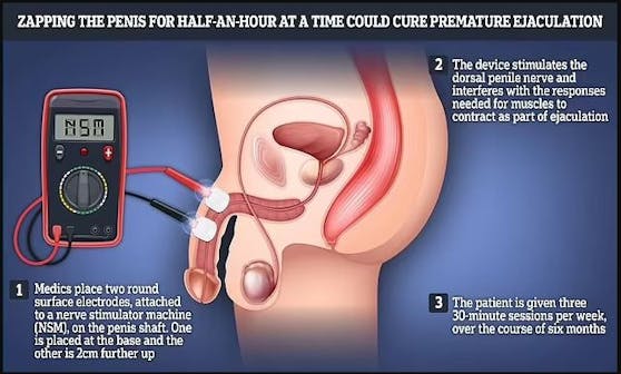 Bei der Behandlung werden 2 Elektroden auf dem Penis angebracht, durch die im Anschluss Strom geleitet wird.&nbsp;