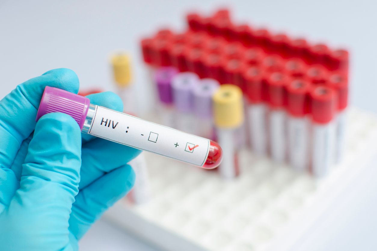 Blood sample positive with HIV