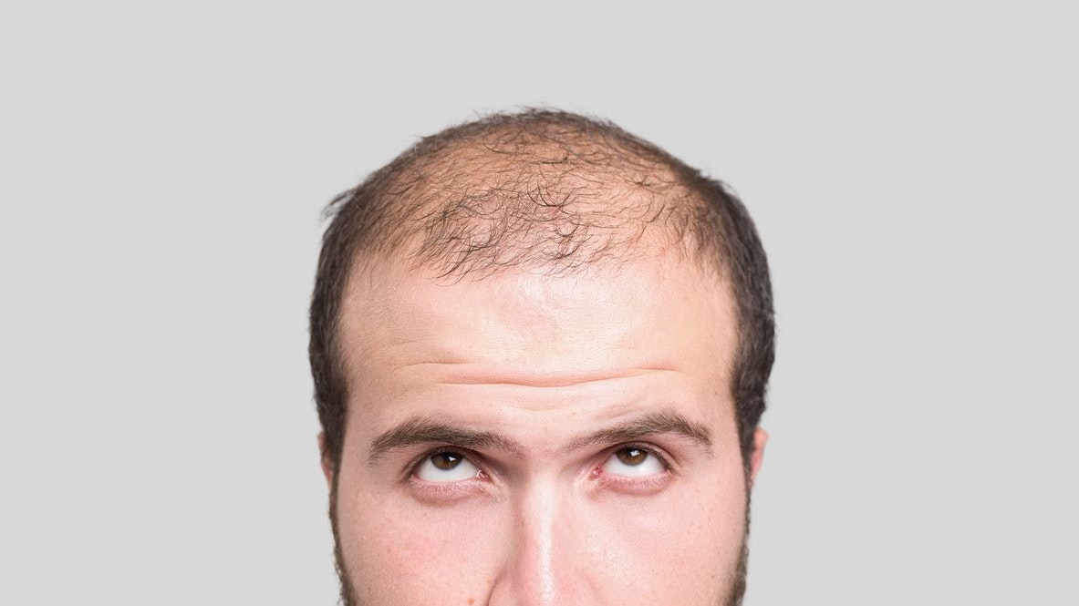 Close up of bald young man, front view