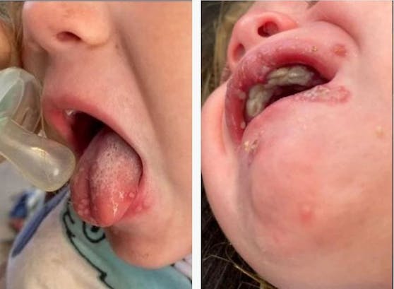 Drei Wochen plagten die kleine Sadie eitrige Bläschen, Schmerzen und Fieber. 