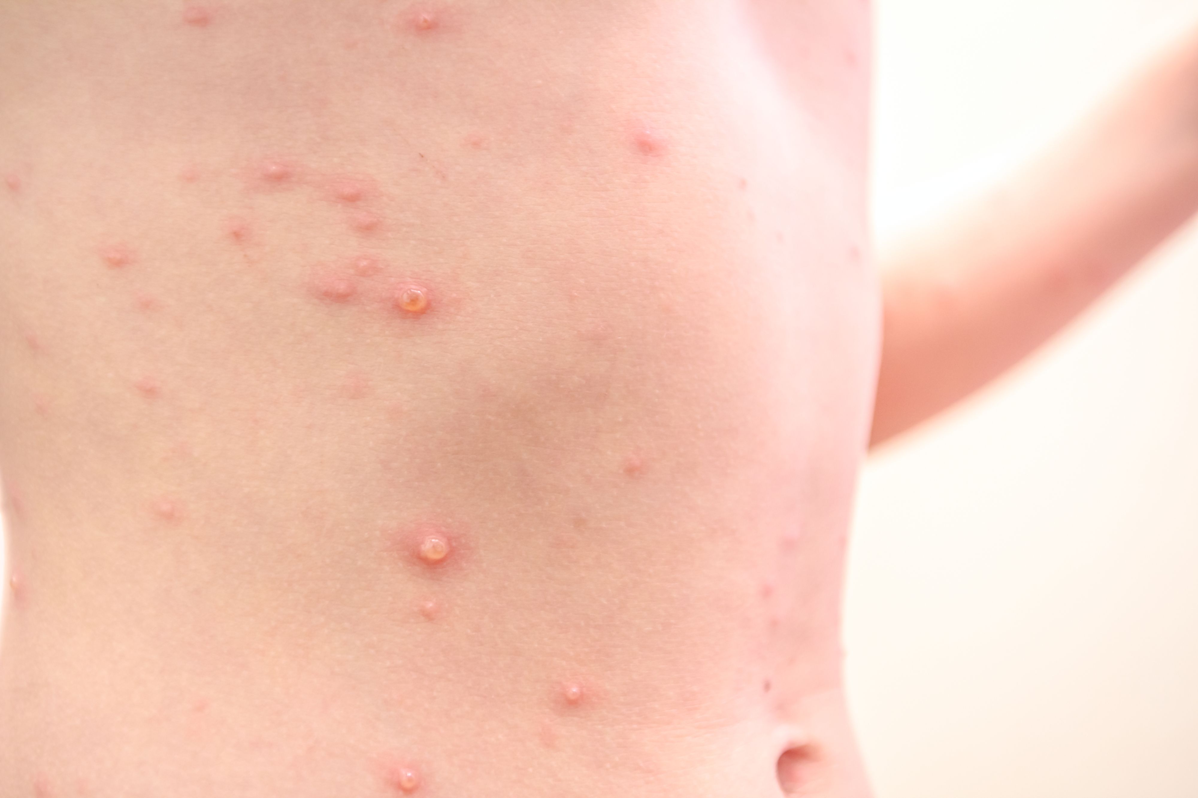 Child with virus of varicella has measles, chicken pox, rubella all over the body. Viral Diseases