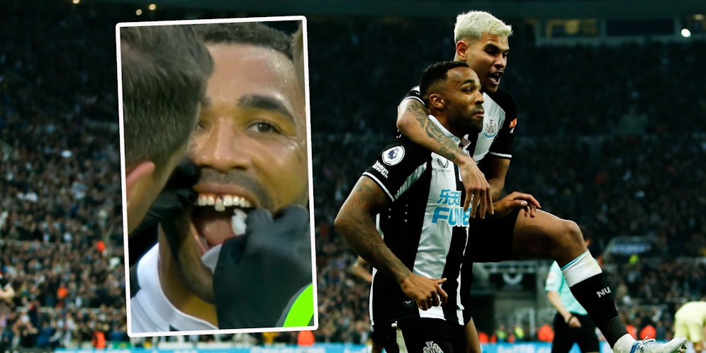 Callum Wilson führt Newcastle zum Sieg, verliert einen Schneidezahn.