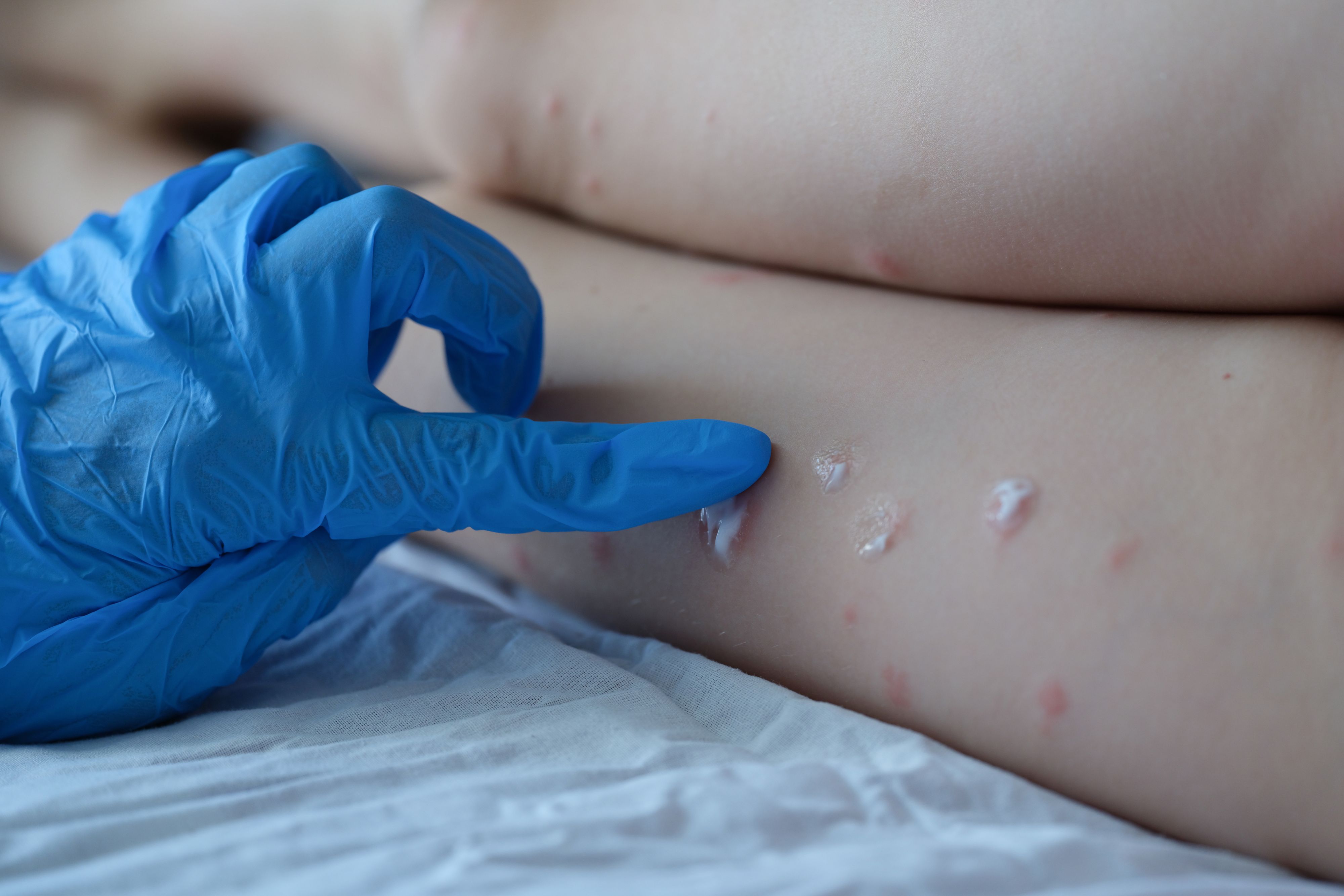 Affenpocken können sich in Form mehrerer Symptome bemerkbar machen. Eines davon ist der typische Ausschlag.