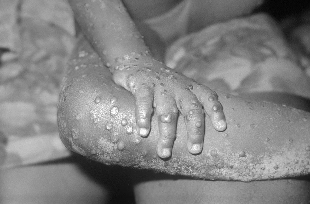 Zu den Affenpocken-Symptomen zählen: Plötzlich einsetzendes Fieber, starke Kopfschmerzen, Rückenschmerzen, Halsschmerzen, Husten, häufig auch Lymphknotenschwellungen. (Im Bild: Vierjähriges Mädchen mit Affenpocken-Schäden auf der Haut, 1971)