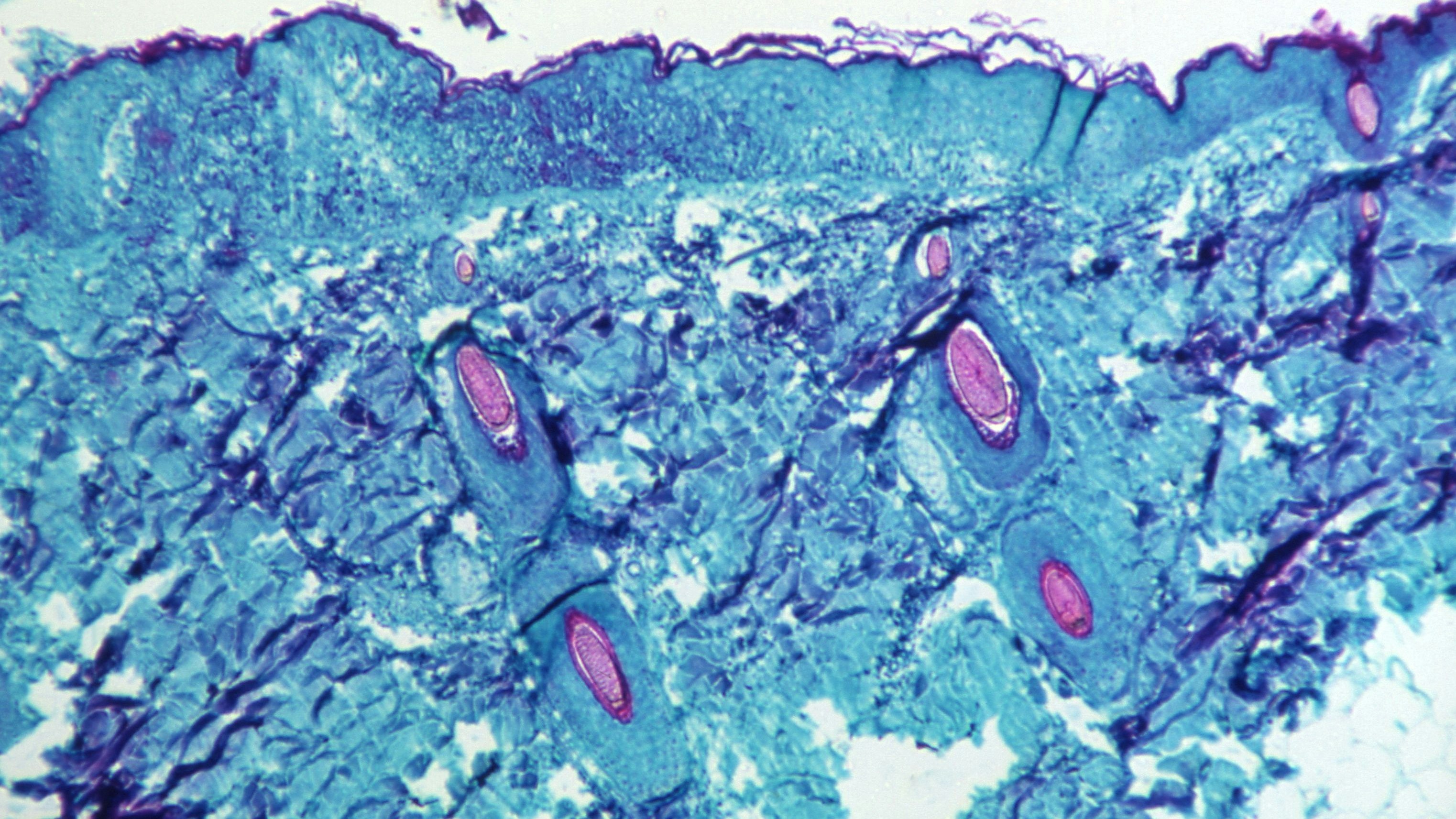 A section of skin tissue, harvested from a lesion on the skin of a monkey, that had been infected with monkeypox virus, is seen at 50X magnification on day four of rash development in 1968. CDC/Handout via REUTERS. THIS IMAGE HAS BEEN SUPPLIED BY A THIRD PARTY. IT IS DISTRIBUTED, EXACTLY AS RECEIVED BY REUTERS, AS A SERVICE TO CLIENTS