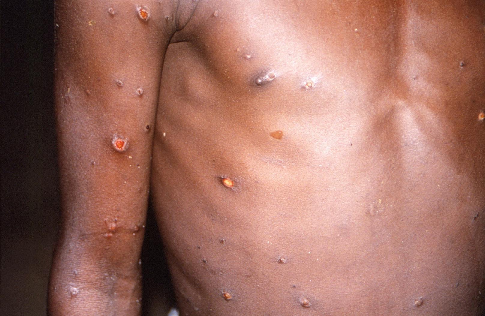 Die in Europa und den USA auftretende westafrikanische Variante des Virus führe in Afrika bei etwa einem Prozent der Erkrankten zum Tod.